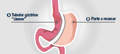 Sleeve-gastrico