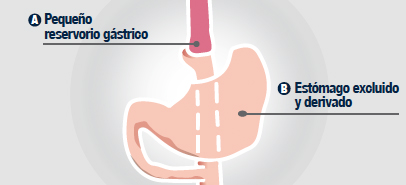 by-pass-gastrico-proximal