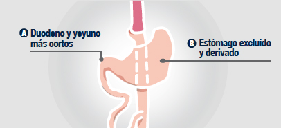 derivacion-gastro-yeyunal-distal