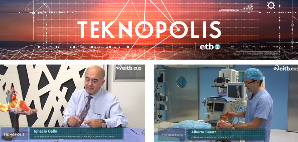 El Servicio de Cirugía Cardiovascular de Policlínica Gipuzkoa ha participado en el programa "Teknopolis" de ETB