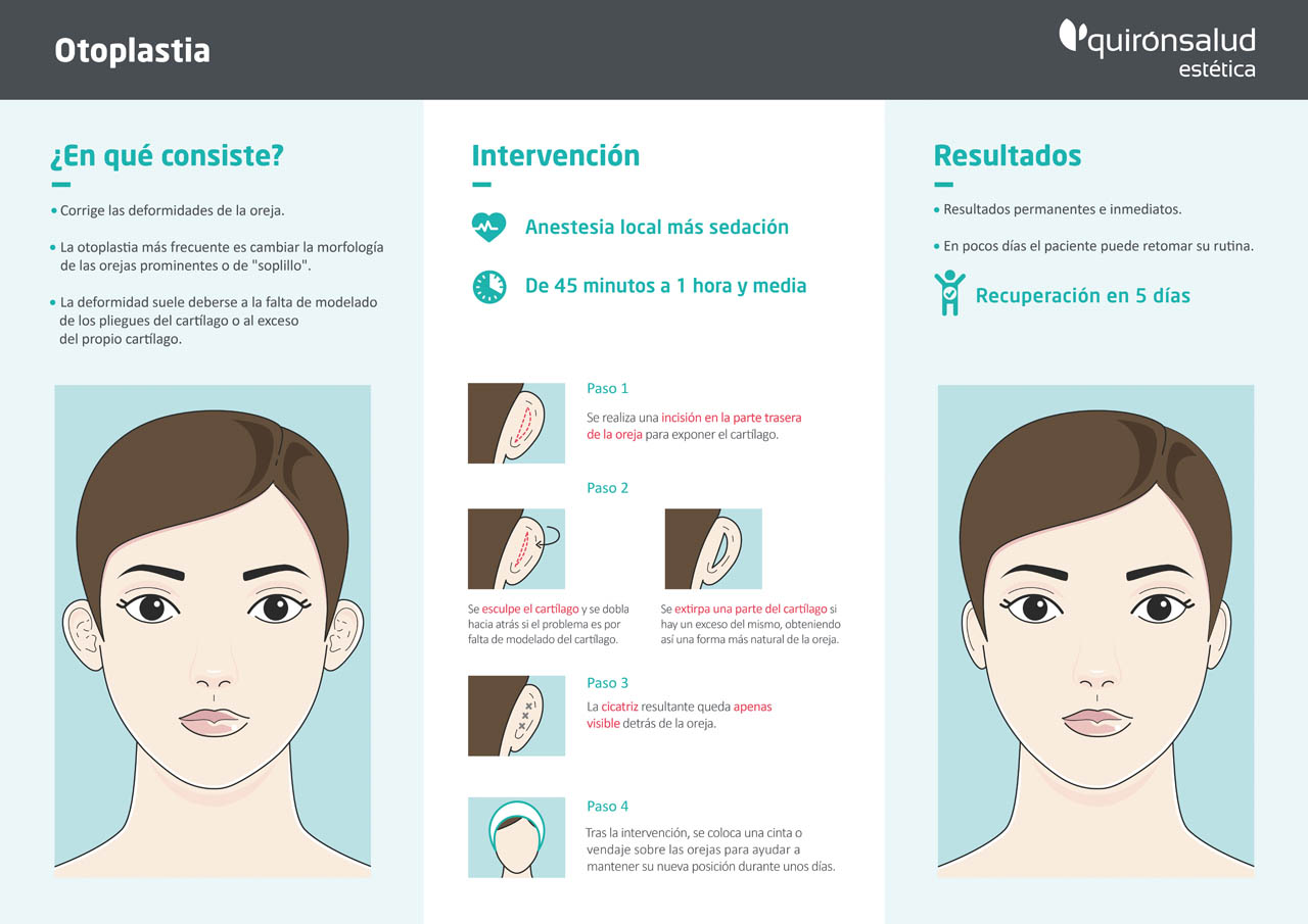 Otoplastia