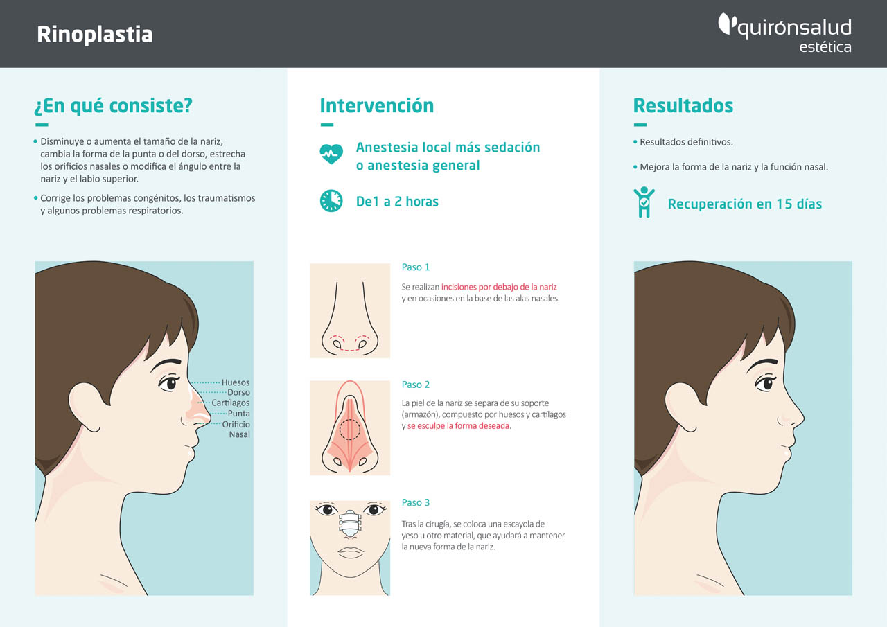 Rinoplastia Rinoplastia