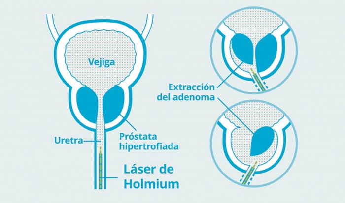 HOLEP_técnica