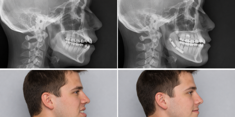 Cirugía ortognática